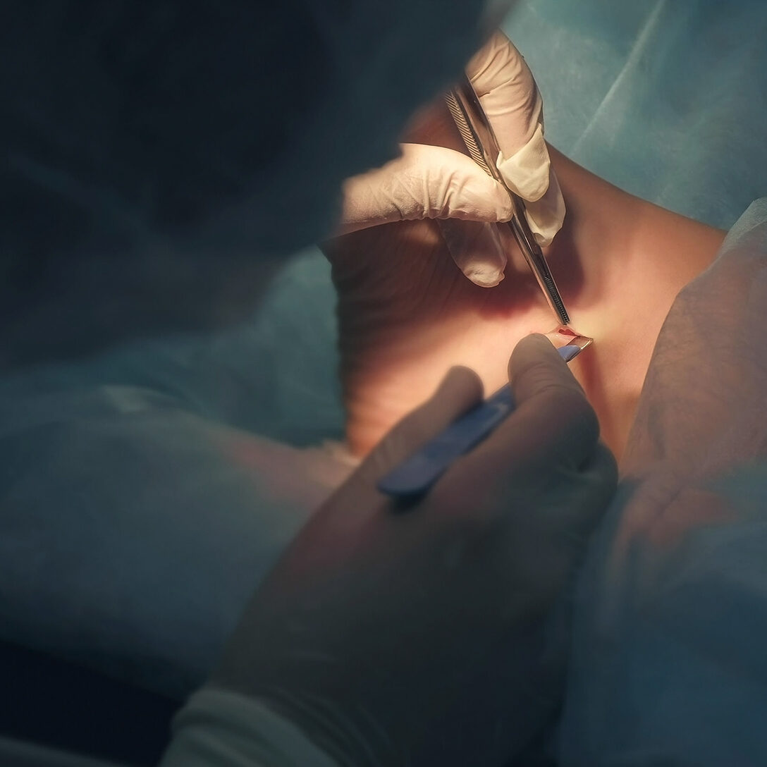 mohs surgeon carrying out dermatological surgery