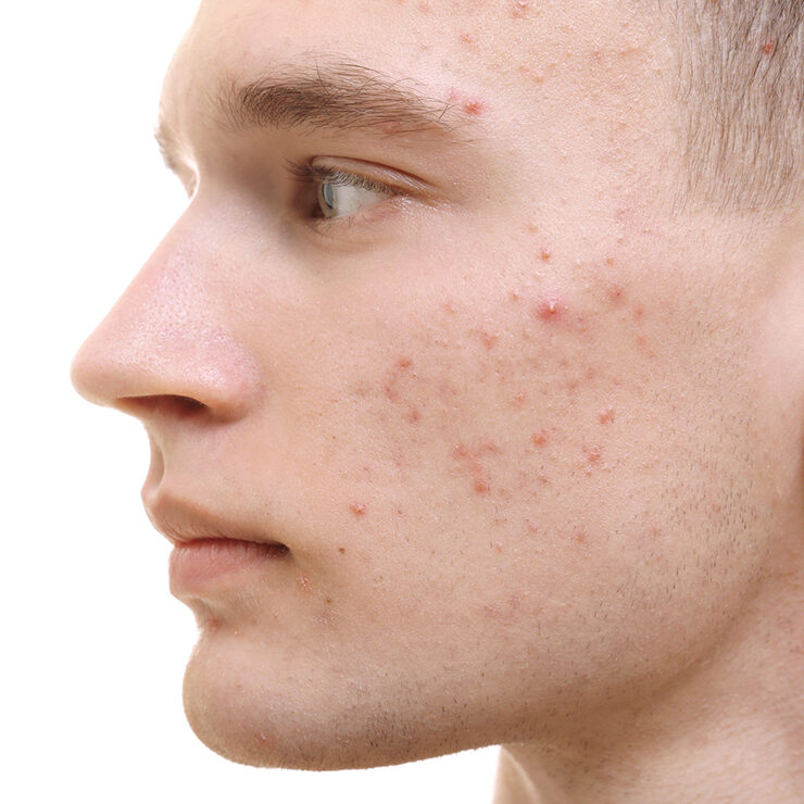 Dr Faisal Dermatology for acne